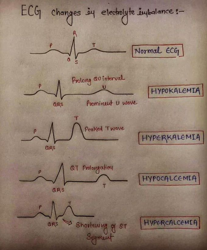 Common ECG changes