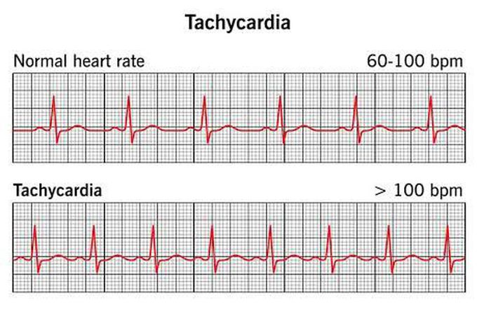 This is the difference between Normal heart rate and Tachycardia.