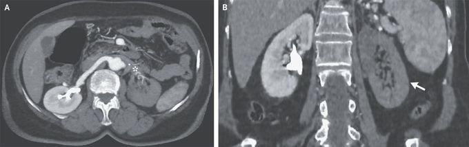 Renal Artery Thrombosis in Essential Thrombocythemia