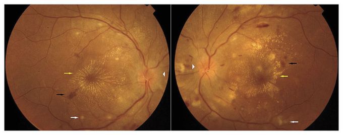 Hypertensive Retinopathy Associated with Preeclampsia