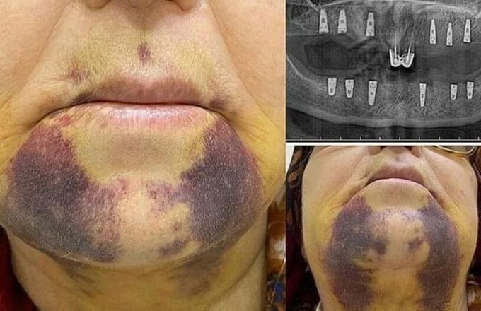 Ecchymosis
