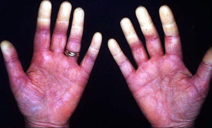 Photo of a patient with Raynaud phenomenon!! 