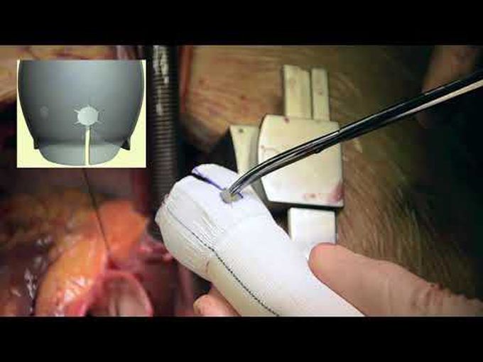 Aortic Root Remodeling With Modified Sleeve Procedure
