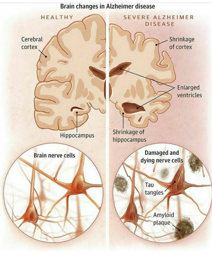 Alzheimer disease