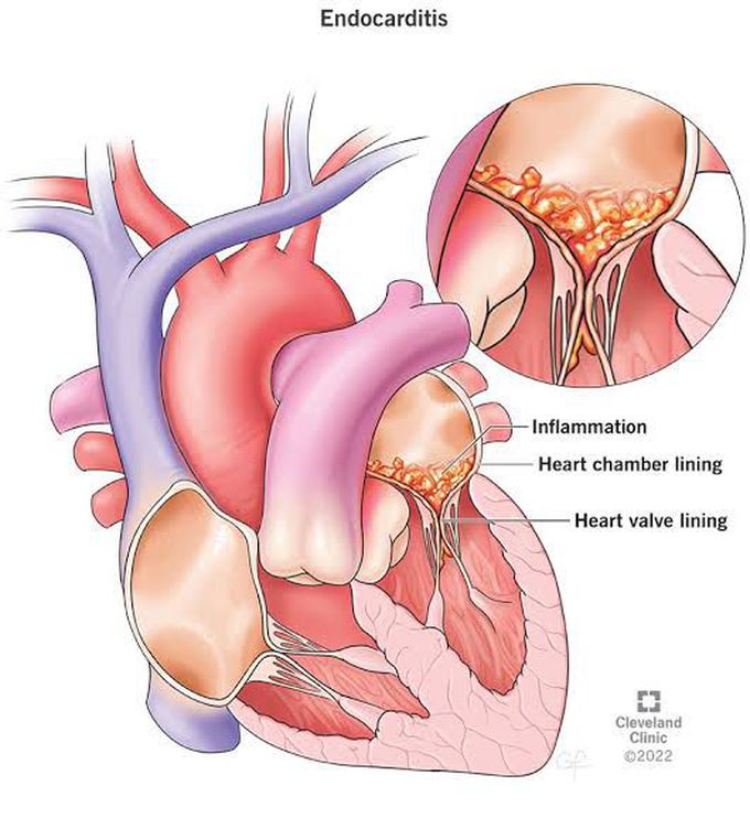 Endocarditis