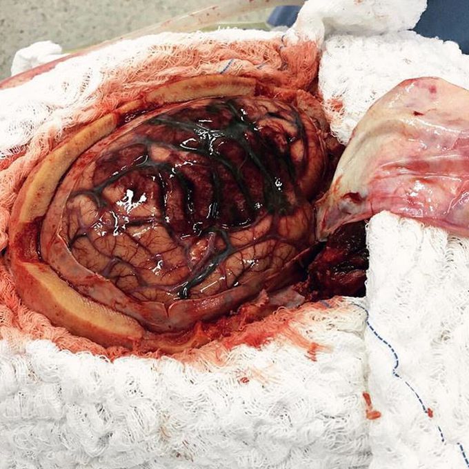Craniotomy done for a patient suffering from stroke