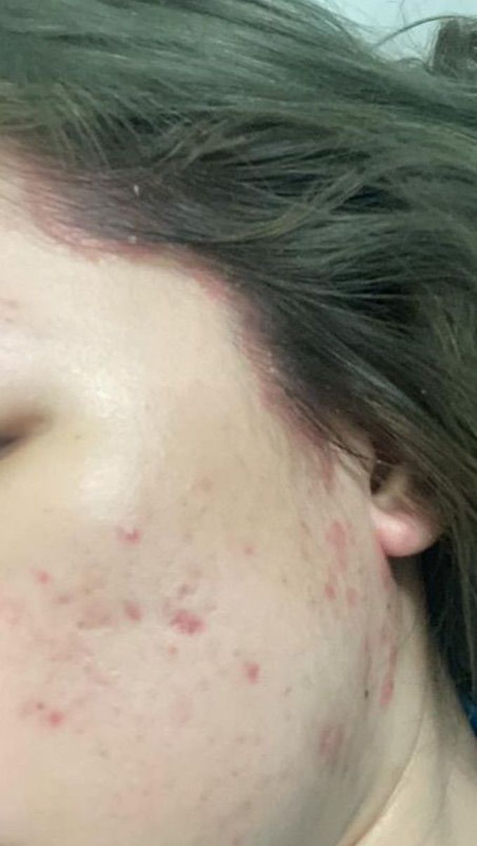 Is this scalp psoriasis?