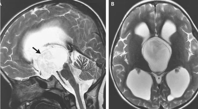 neurosurgery
