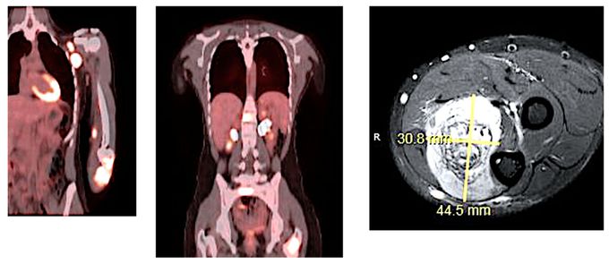 Rhabdomyosarcoma and Extraosseous Ewing Sarcoma