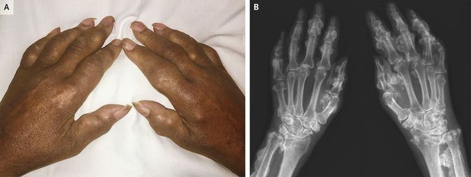 Voriconazole-Induced Periostitis