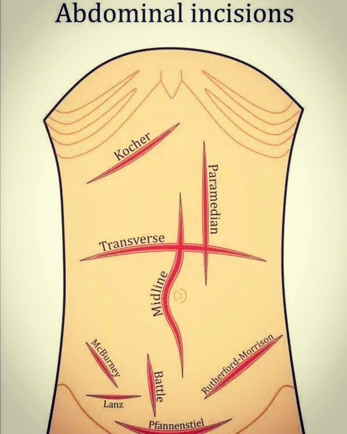 Abdominal Incisions