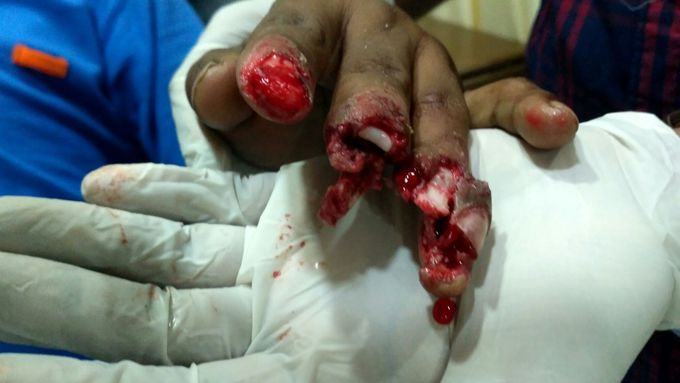 Avulsion