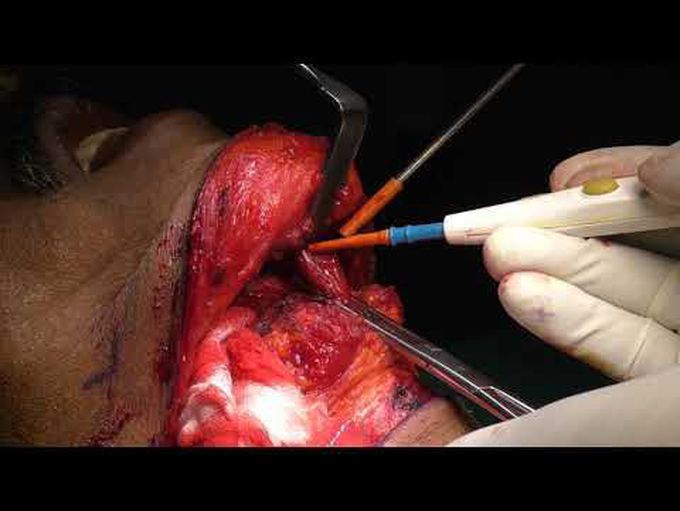 Lingual pull through for total glossectomy
