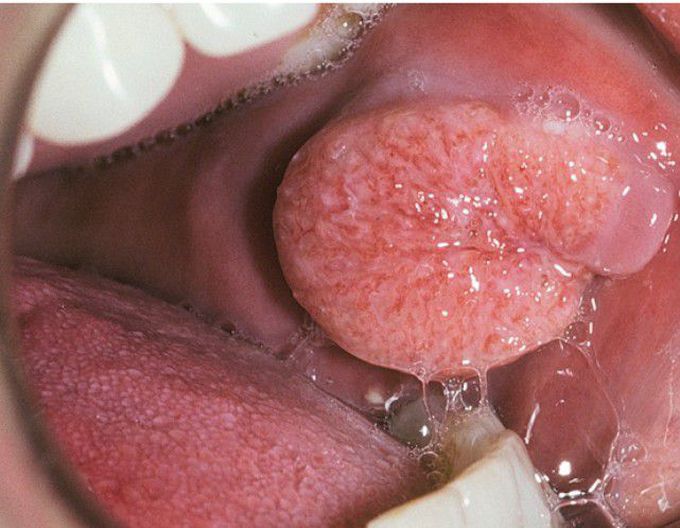 Blastomycosis