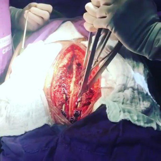 Scoliosis