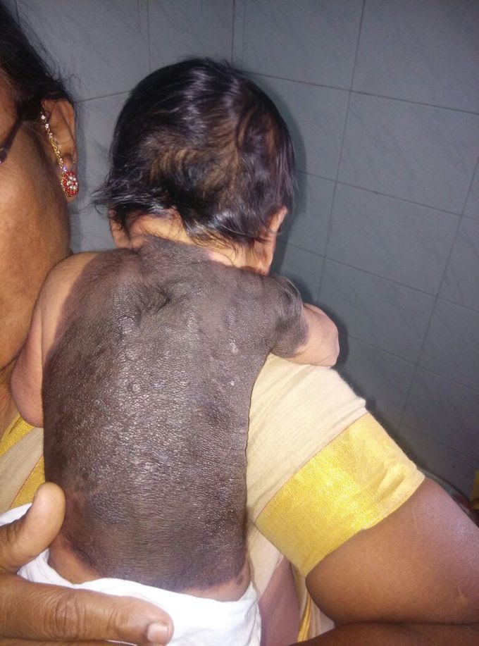 Skin disorder