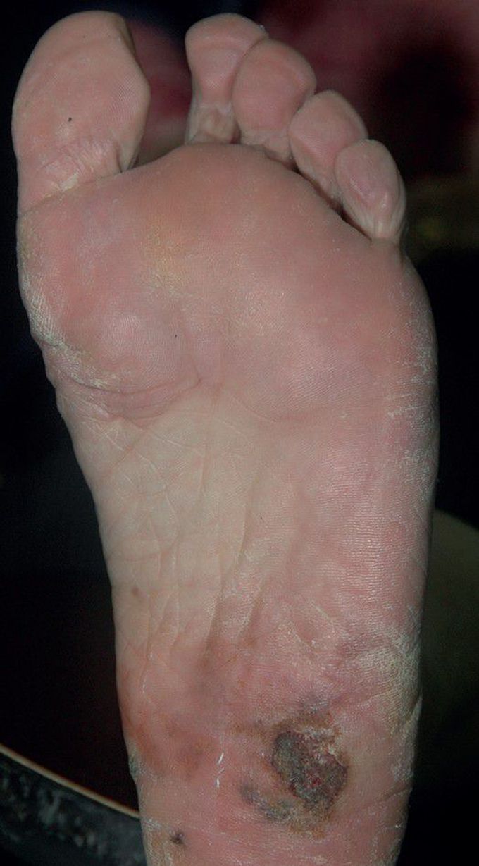 Non-healing pigmented macule with ulceration on the foot