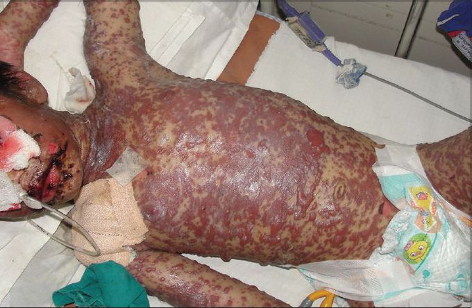 TOXIC EPIDERMAL NECROLYSIS