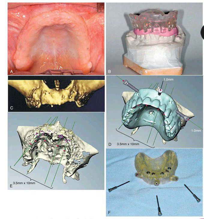 Maxilla rehabilitation