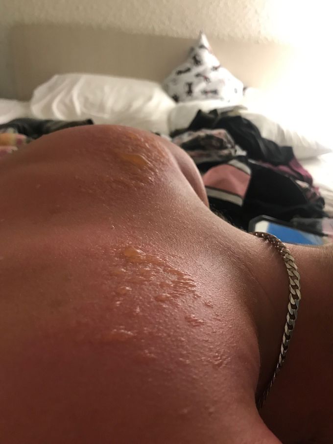 Sunburn