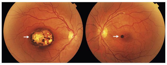 Chorioretinal Toxoplasmosis