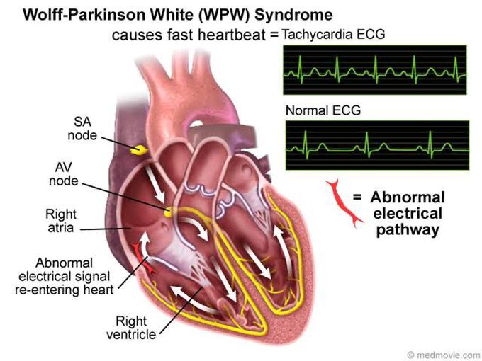 Wolff-Parkinson-White Syndrome