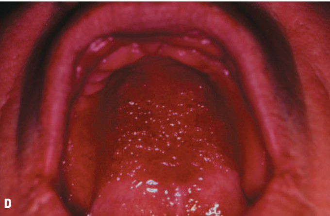 Denture stomatitis type 3