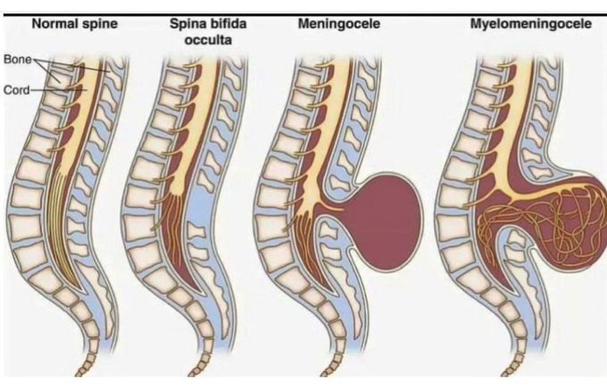 Spina Bifida