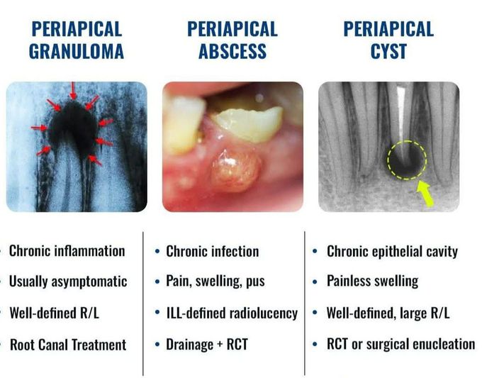 Periapical Pathologies