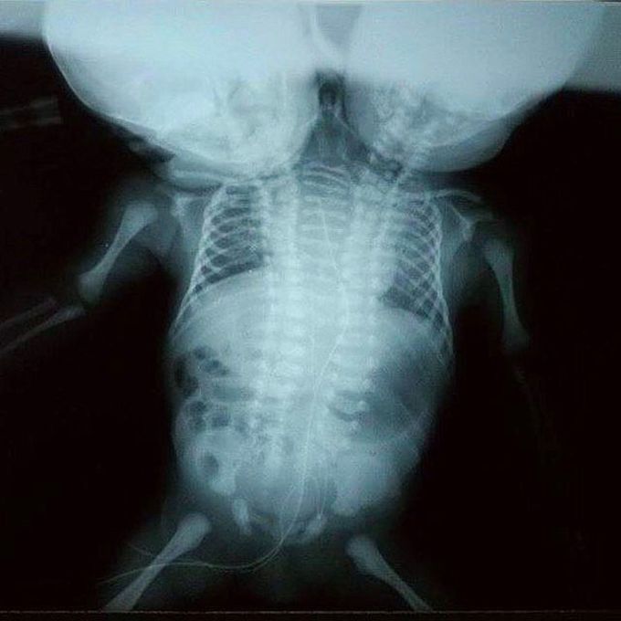 Conjoined Twins X-Ray
