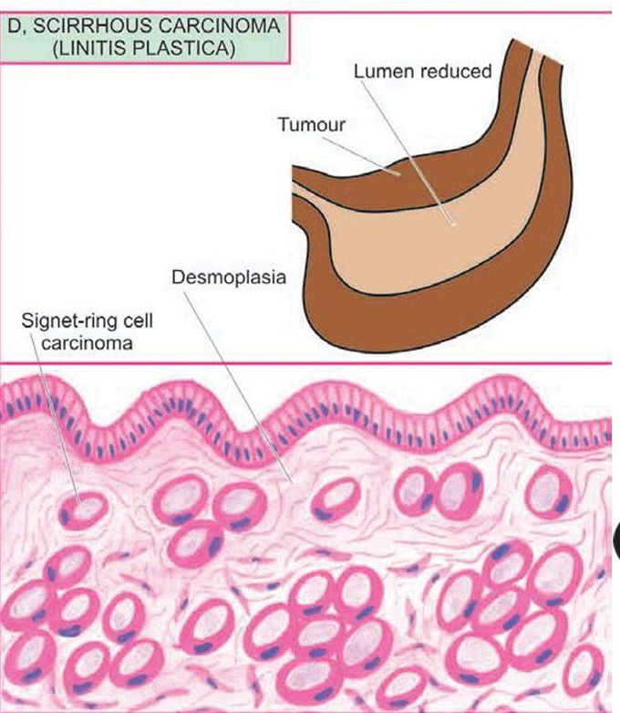 Gastric carcinoma