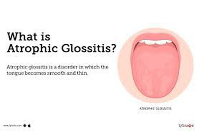 Atrophic glossitis