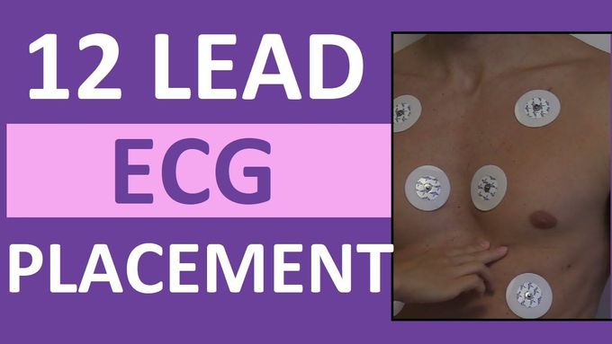 12 Lead ECG Placement of Electrodes