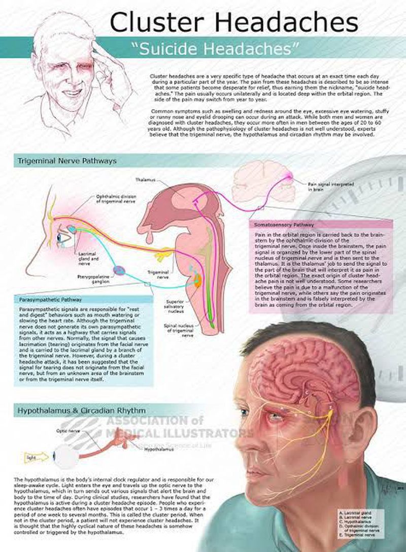 Cluster headache - MEDizzy