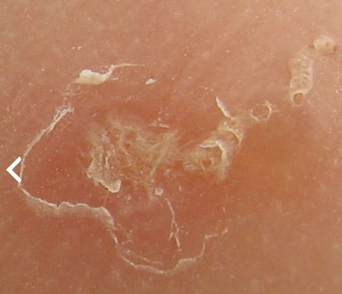 Scabies----a contagious skin infestation caused by the mite Sarcoptes scabiei
