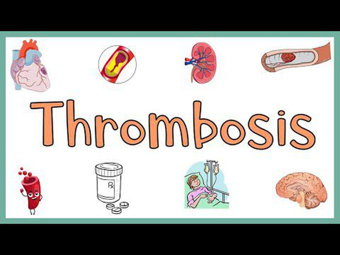 Thrombosis