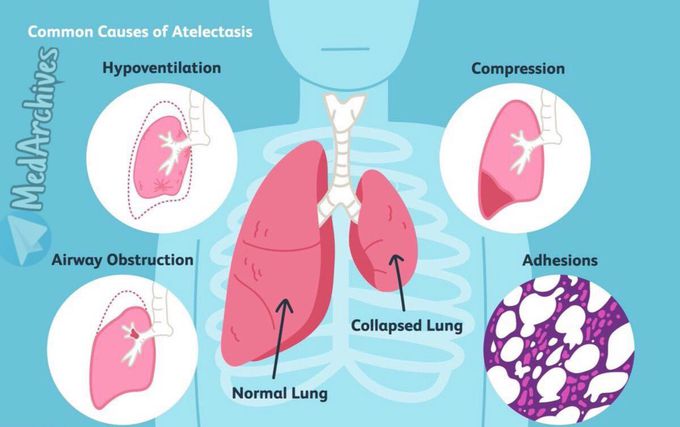 Atelectasia