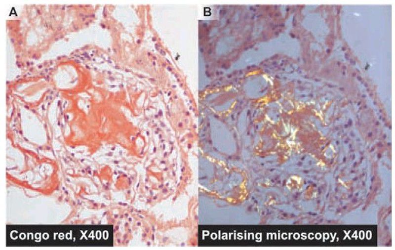 Amyloidosis kidney, Congo red stain. - MEDizzy