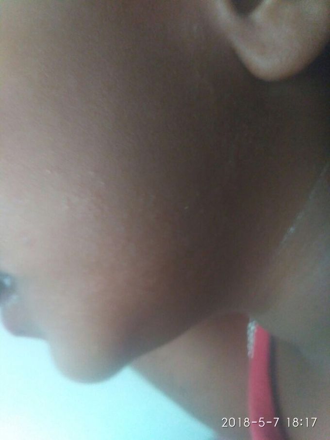 Child with rash