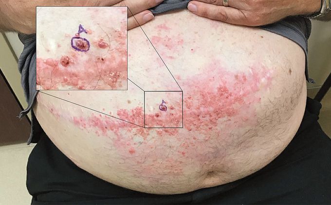 Cutaneous Colon Cancer Metastases in a Surgical Scar