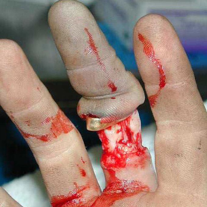 Degloving injury of a finger!