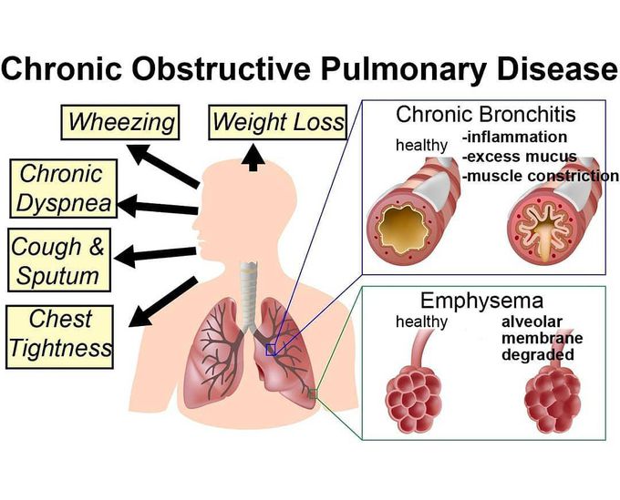 COPD