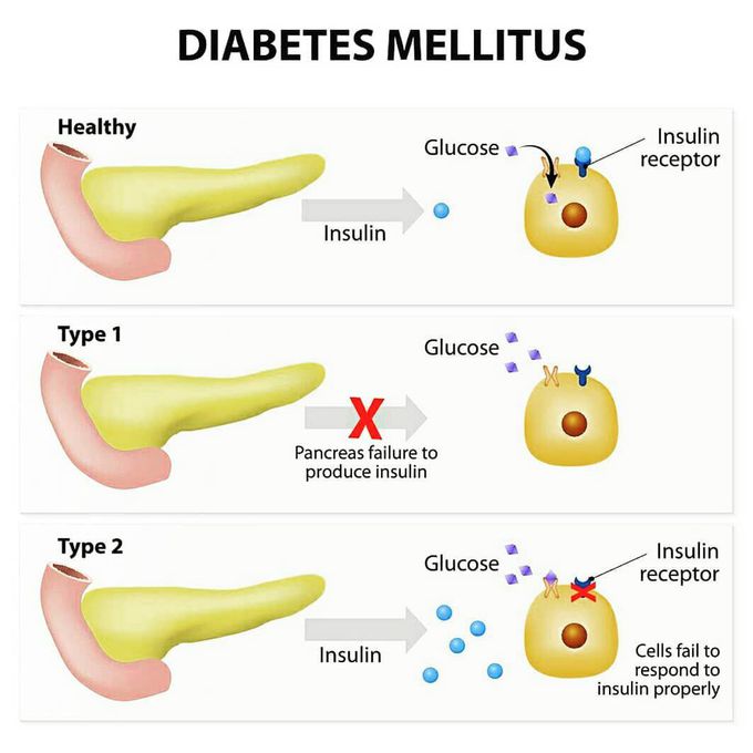 Diabetes mellitus