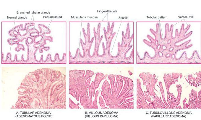 Adenoma