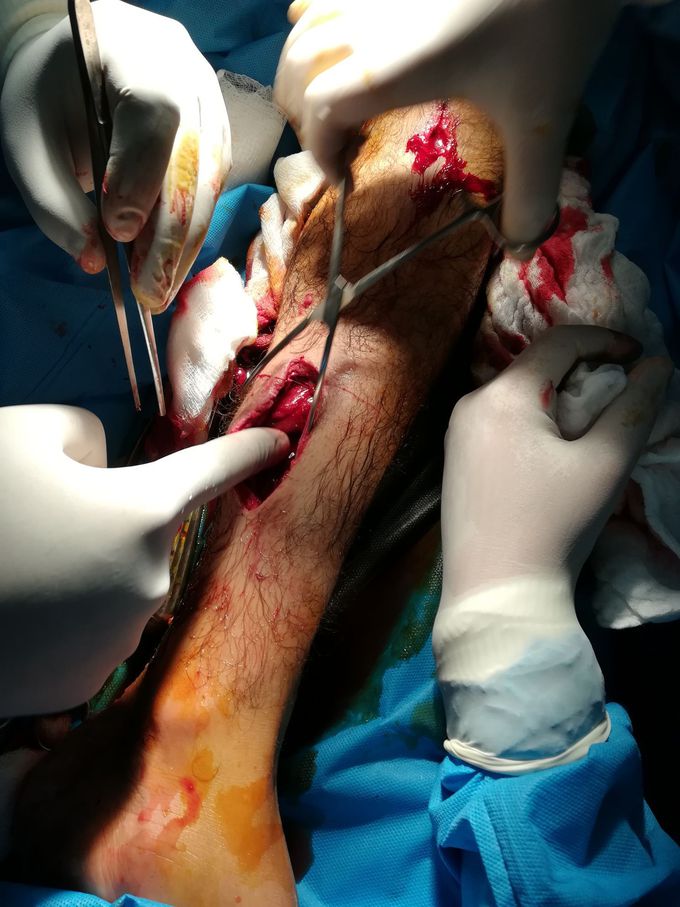 Opne surgical wound