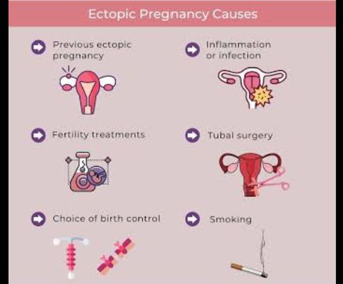 Causes of ectopic pregnancy