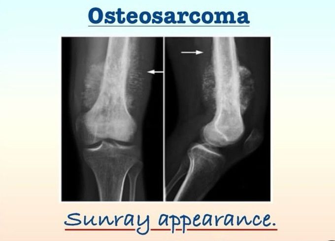 Osteosarcoma