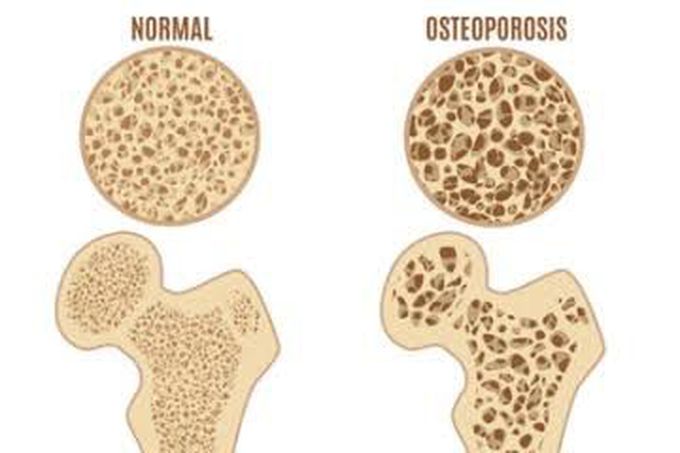 Treatment of osteoporosis