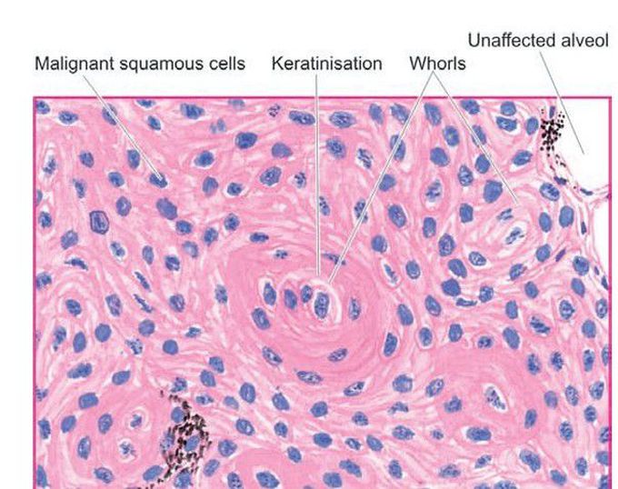 Squamous cell carcinoma of the lung.