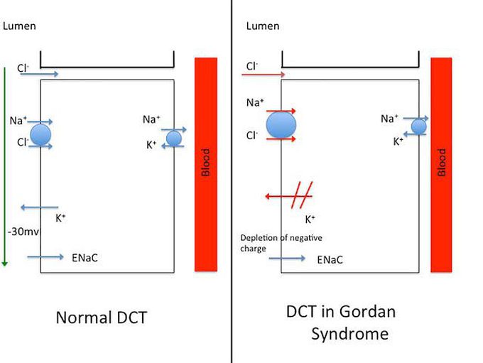 Gordons syndrome